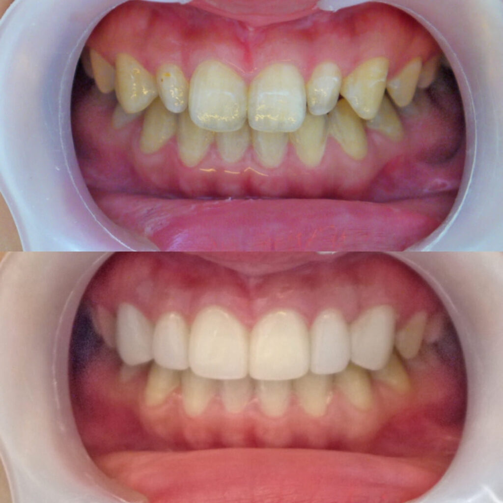 治療症例｜20代・女性・矮小歯によるすきっ歯（離間）