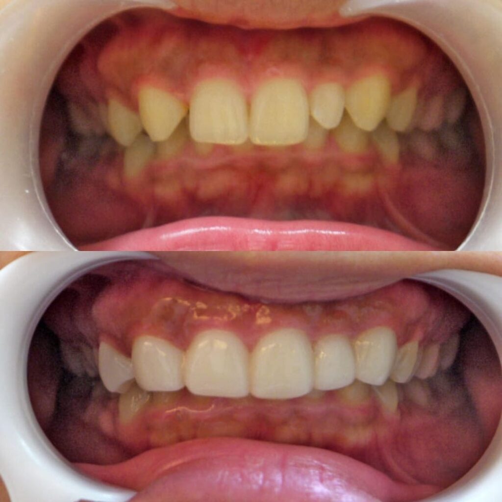 治療症例｜30代・女性・先天性欠損によるすきっ歯（離間）・歯の不揃い