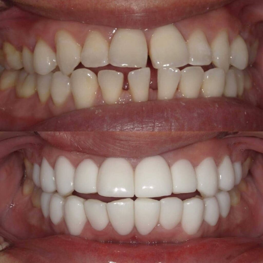 治療症例｜30代・男性・上下のすきっ歯（離開）