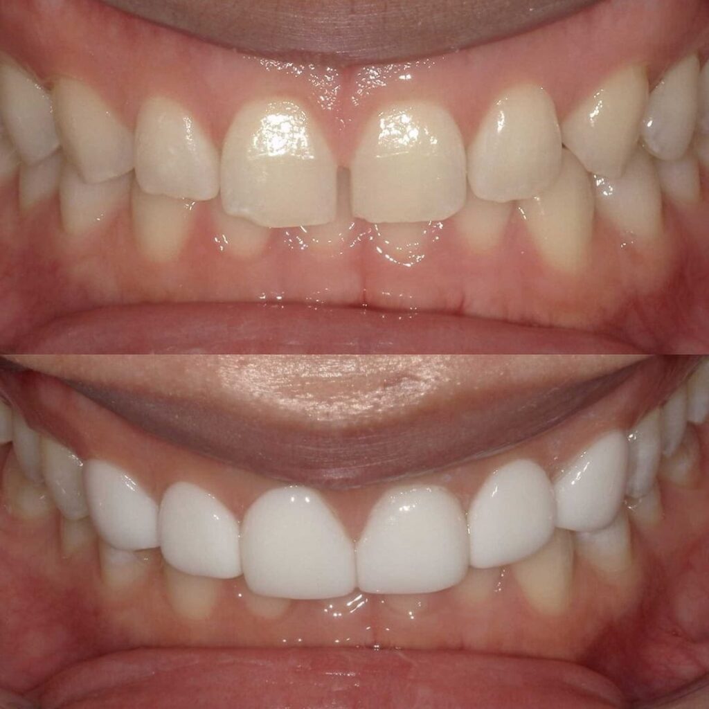治療症例｜20代・男性・すきっ歯（正中離開）・歯の不揃い