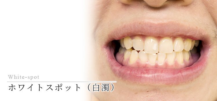 東京・銀座で「安いホワイトスポット（アイコン・白濁）治療