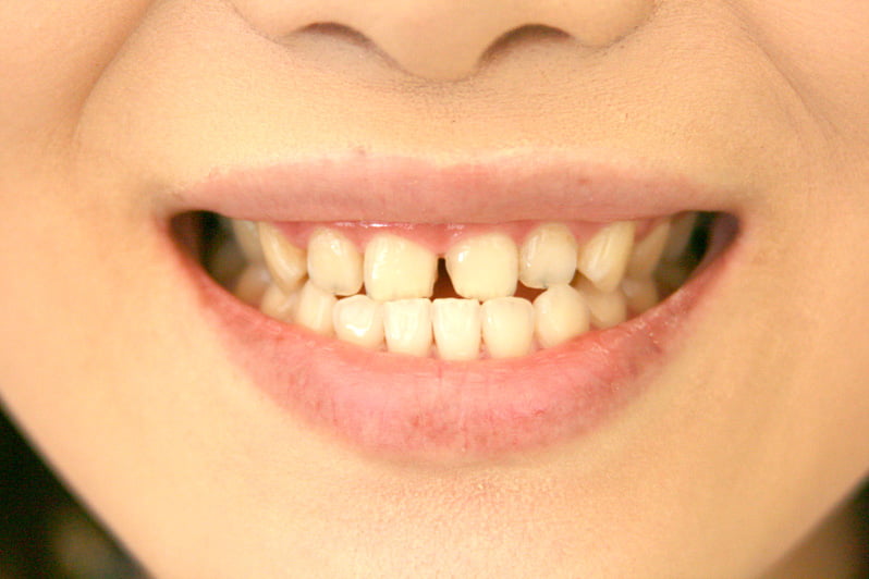 患者様の歯を診断イメージ画像