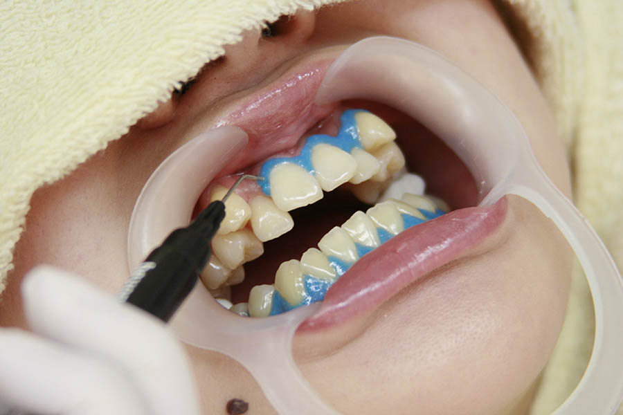 歯茎の保護イメージ画像