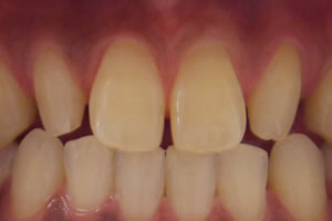 すきっ歯 歯の隙間 の原因と対策とは 審美歯科 東京 銀座 ティーシーズ のデンタルサロン プレジール