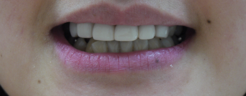30代後半女性 欠損でバランスが悪い歯並びをティーシーズで審美的に回復した症例 審美歯科 東京 銀座 ティーシーズ のデンタルサロン プレジール