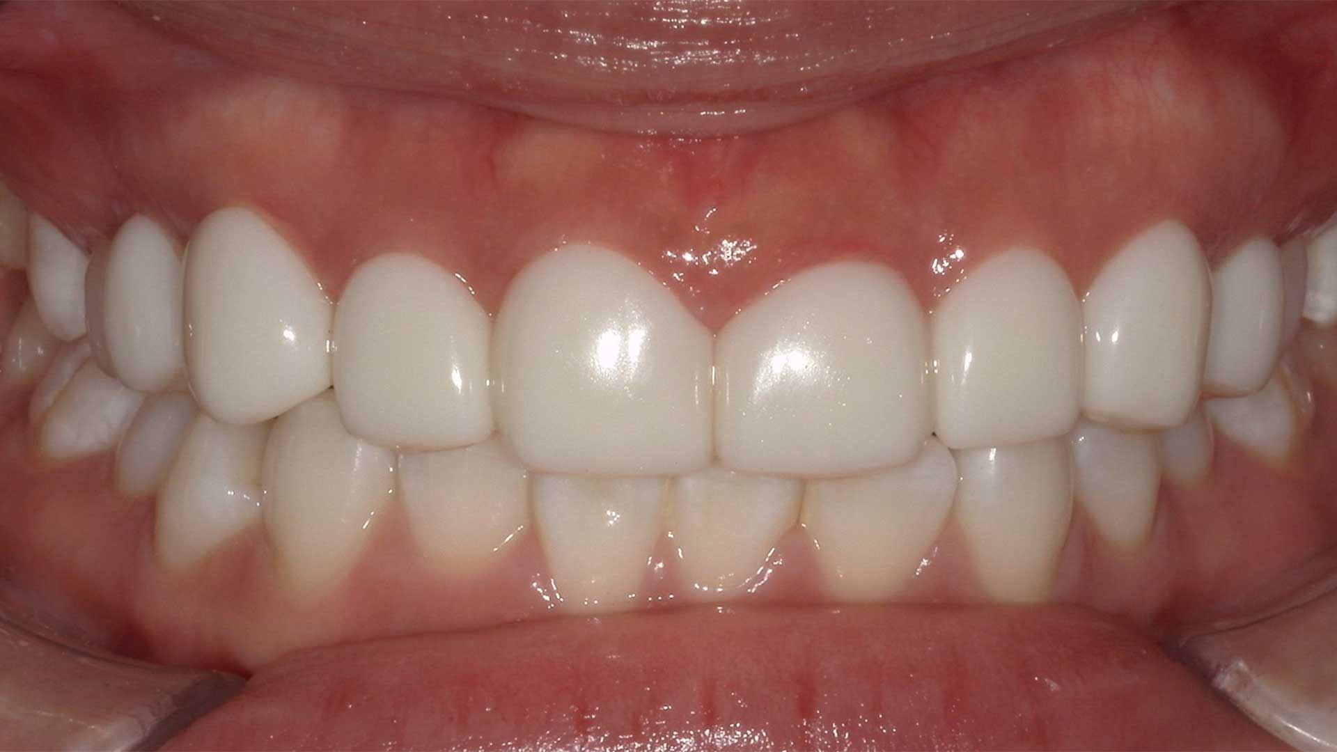 東京・銀座の審美歯科が提案した、白斑を削らずに隠すティーシーズ治療