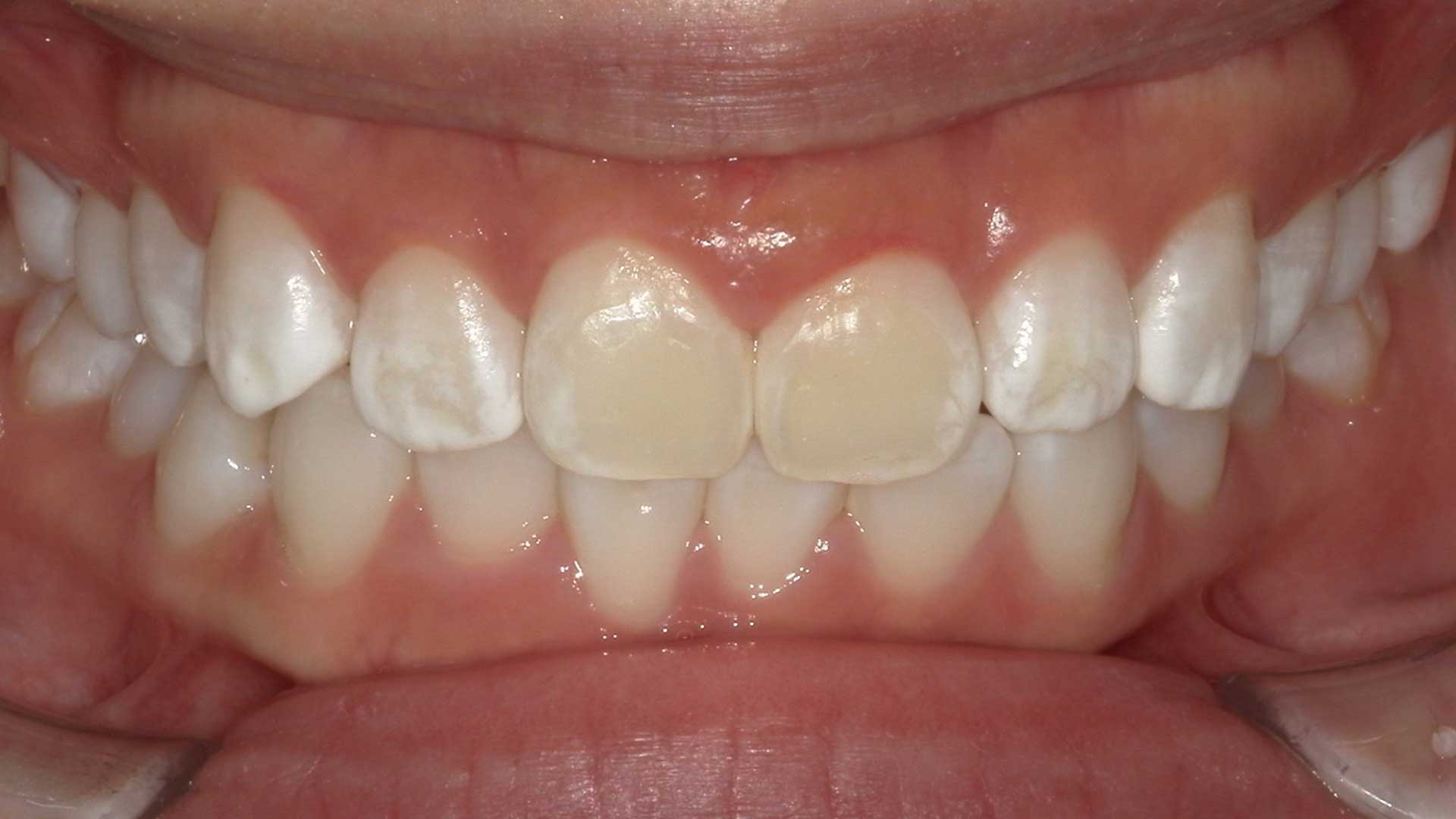 東京・銀座の審美歯科に来院された20代女性の、歯の白斑に関するお悩み