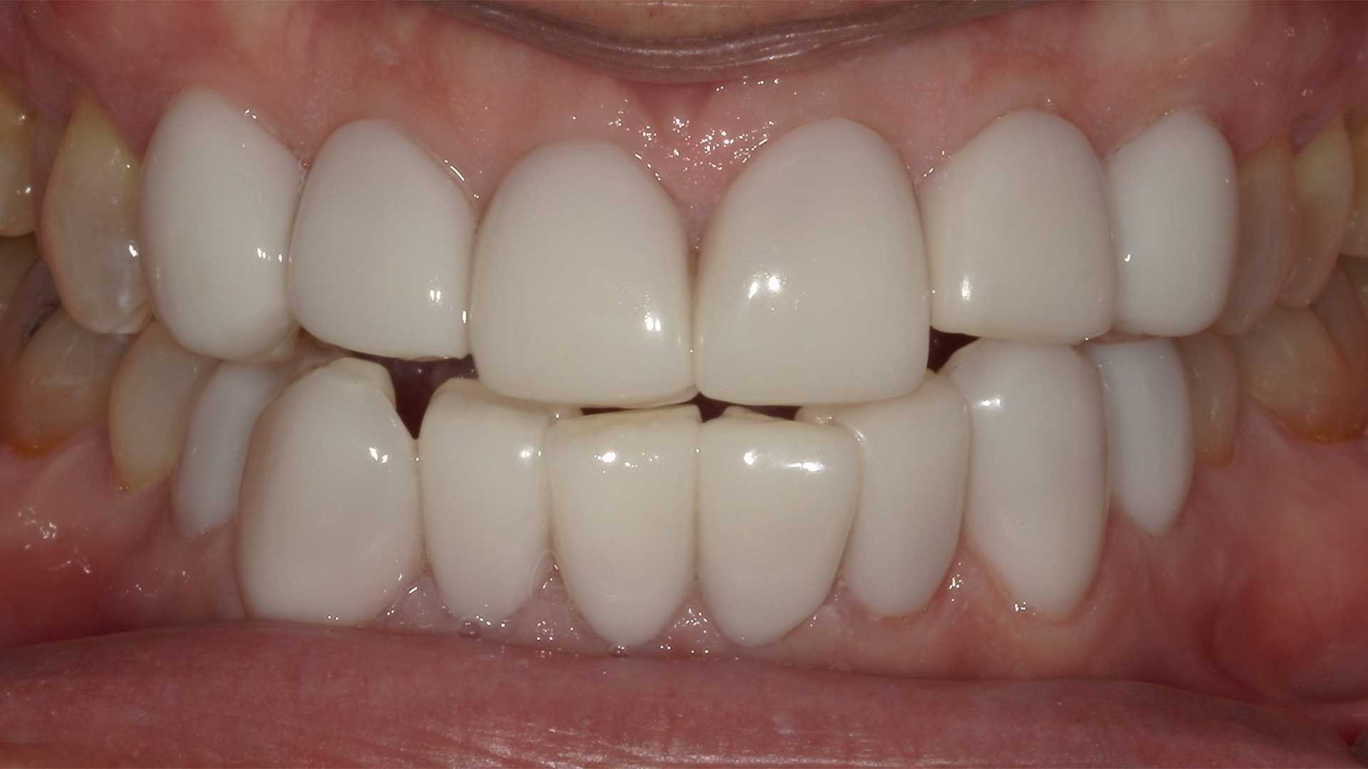 東京・銀座の審美歯科での治療後、白く美しい歯並びへと変わった口元の症例