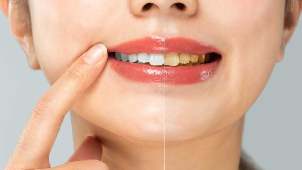 東京の審美歯科が提案するPMTCとホワイトニングを組み合わせた輝く白い歯を維持する黄金サイクル