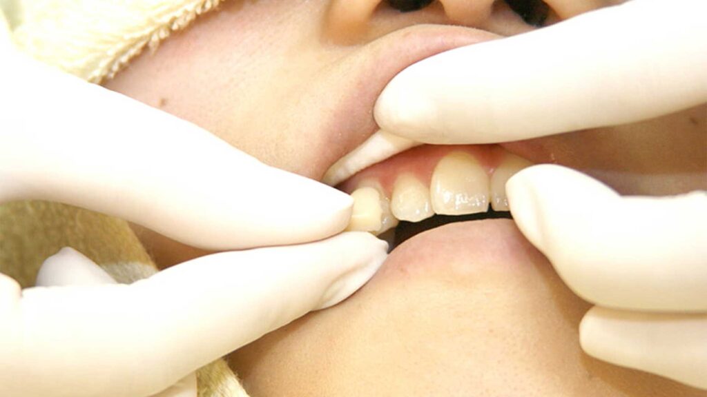 東京銀座の審美歯科で専門家による高濃度フッ素塗布を受ける様子