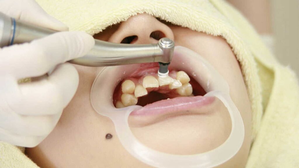 銀座の審美歯科が解説する乱杭歯（叢生）になってしまう主な原因とタイプ